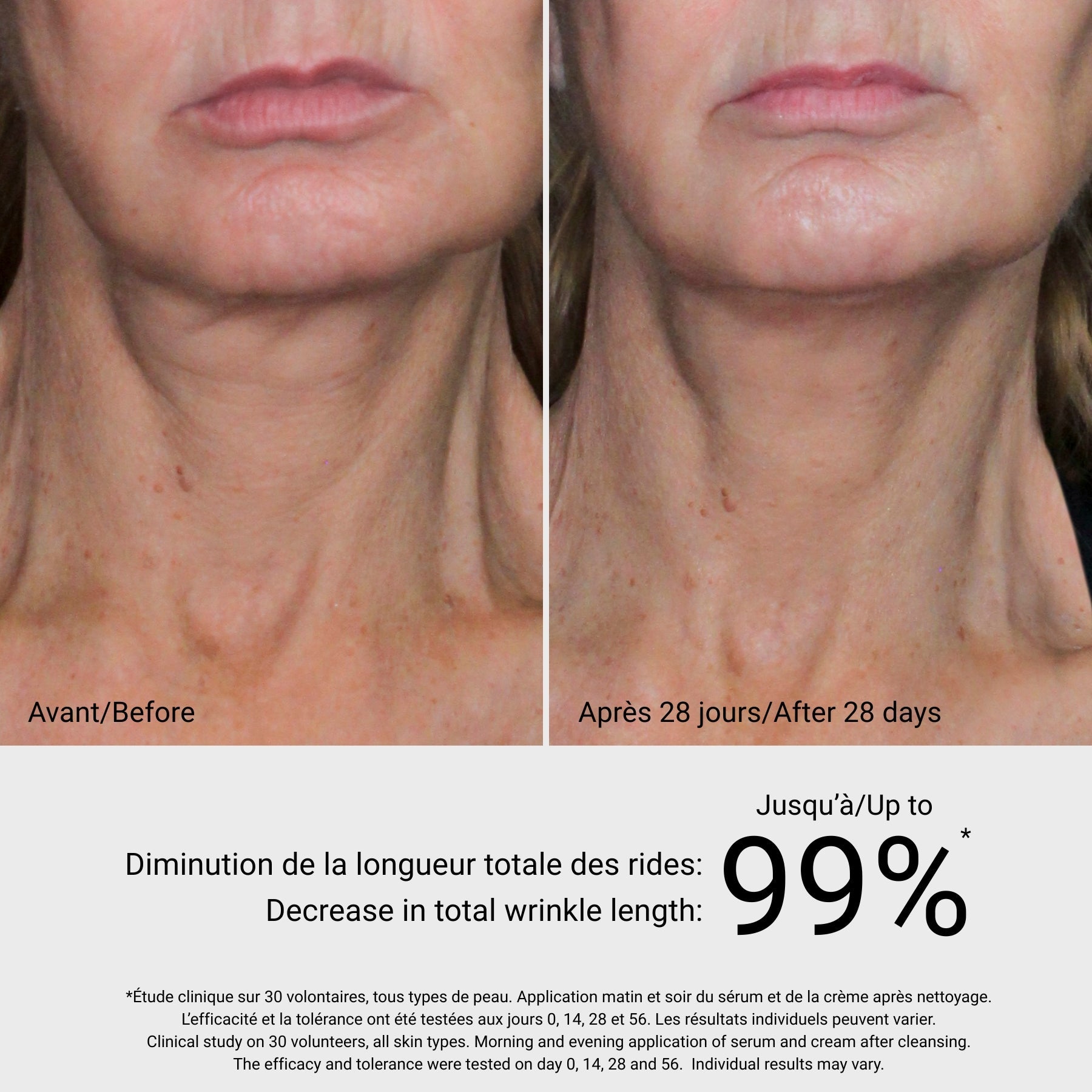 4D Visible Lifting G.M. Collin, avant et après sur l'ovale du visage, à Blainville