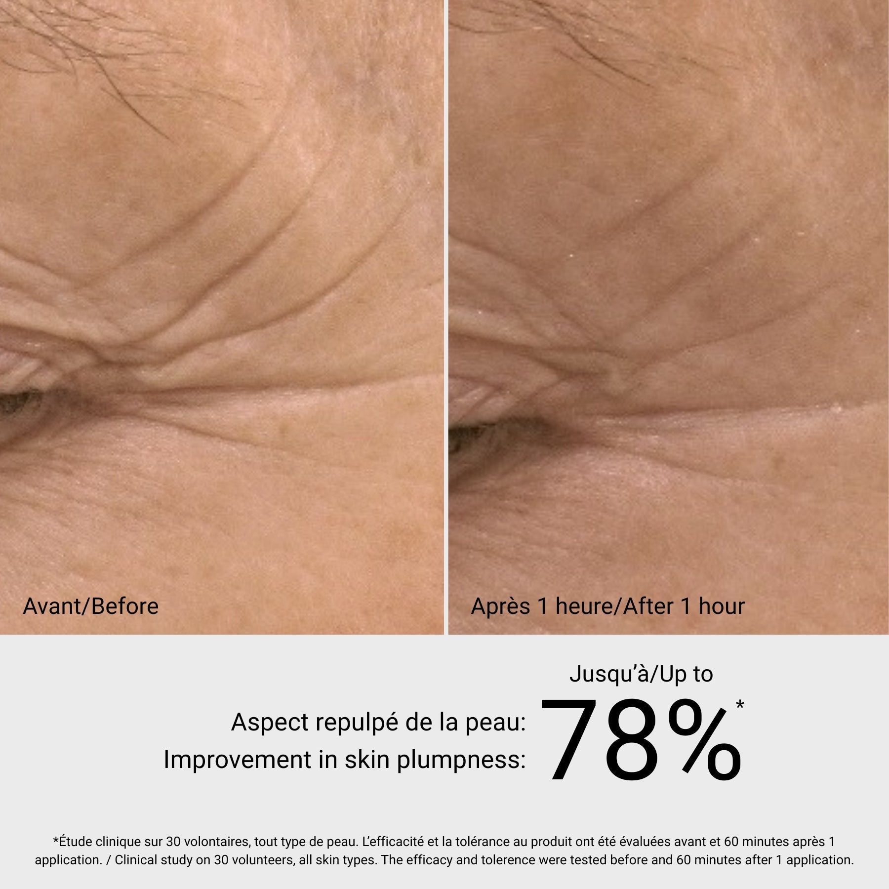 Hyaluronic Filler Sérum G.M. Collin, avant et après, à Blainville